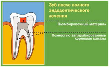 Лечение пульпита 