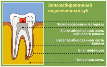 Лечение пульпита 