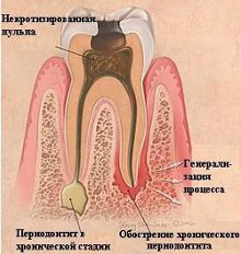 Лечение периодонтита в стоматологи 32 Алмаза